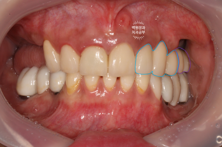 부분틀니 대신 어금니 임플란트를 만들어드립니다. 40대 어금니 상악동 뼈이식 임플란트. 치료기간/비용/과정. 관련 이미지 20