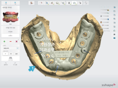 임플란트장인의 마음으로 8개월간 전체임플란트 완성. 치주과 전문의. 관련 이미지 9