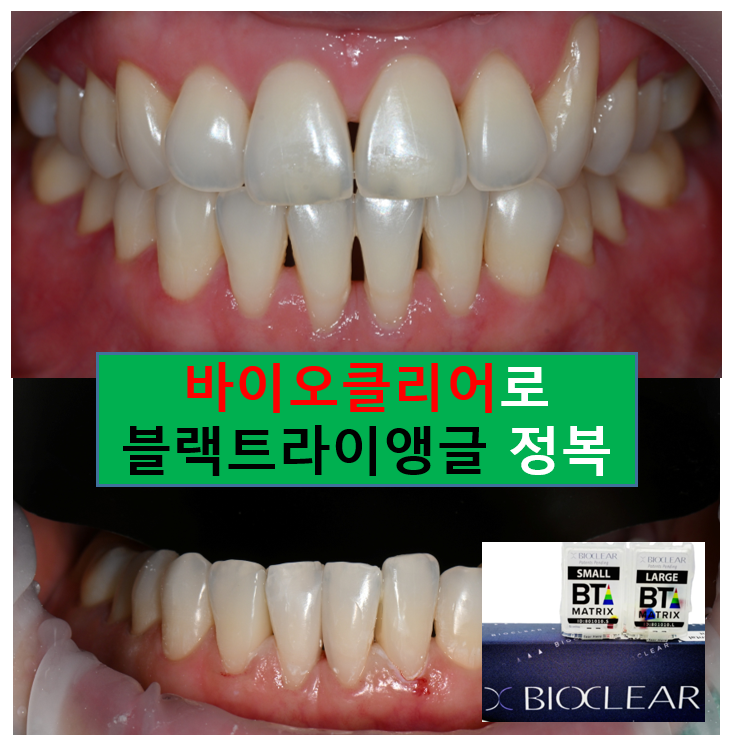 서울 신사역 [레브치과] 아래 앞니 치아 사이 틈 (블랙 트라이앵글) -  바이오클리어 치과에서 깔끔하게 해결. 관련 이미지 14