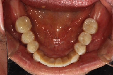 불편한 틀니를 아직도 쓰시나요? 전체 임플란트 치료비용/치료기간/치료과정. 관련 이미지 21