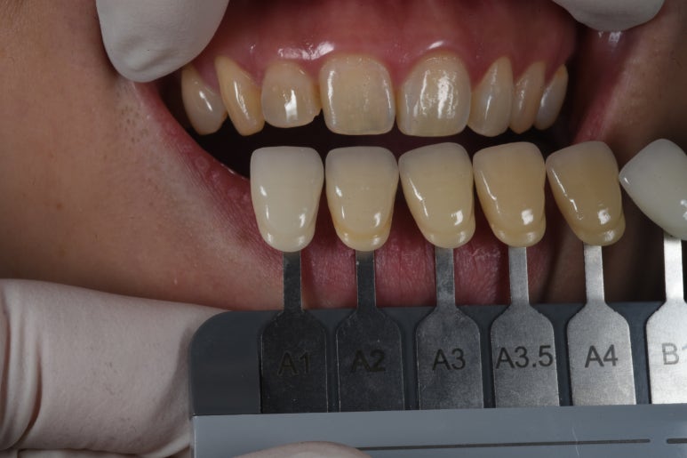 신사역 라미네이트. 결혼식 전 앞니 고민, 얇은 세라믹 레브네이트로 해결! 관련 이미지 11