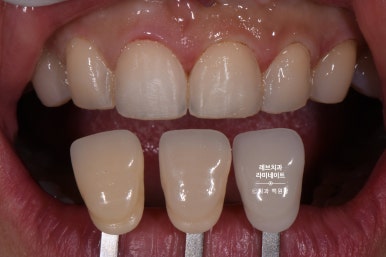 레브네이트 베이직. 치아미백과 치아교정을 한번에! 치아삭제 사진 있음. 신사역 치과 앞니라미네이트 모델/비용/후기. 관련 이미지 22