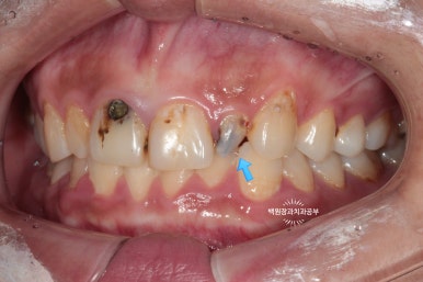앞니에 잇몸염증과 충치가 심해요. 앞니 지르코니아 크라운 성공 후기. 치료과정/치료기간/비용/전후비교. 관련 이미지 4