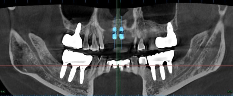 앞니가 풍치로 흔들거려요. 심한 치주염인데 임플란트 가능할까요? 치료과정/치료기간/비용/성공후기. 신금호역 치과 추천. 관련 이미지 12