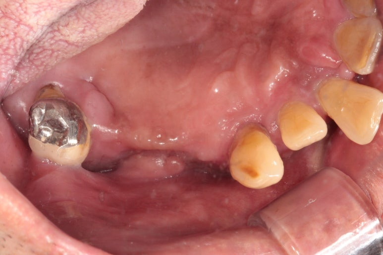 큰 어금니를 잃을 정도의 풍치를 앓으셨다면, 조속한 어금니 임플란트는 필수입니다. 관련 이미지 6