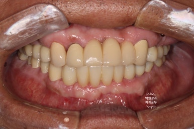 뿌리만 남은 앞니, 어금니가 없어 교합이 무너진 증례. 흡연자의 전체 오스템BA임플란트 재건증례. 치료과정/치료기간/비용/후기. 관련 이미지 25