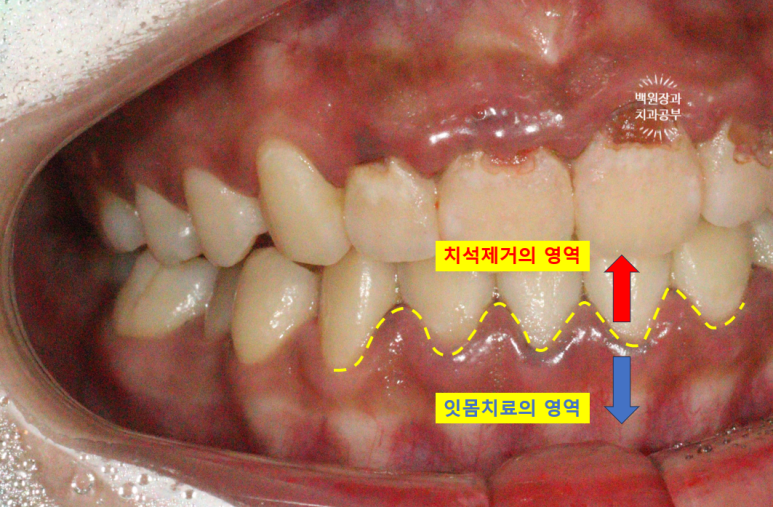 잇몸치료와 앞니 레진치료. 3년이 지난 모습 궁금하지 않으신가요? 3M 레진쓰는 치과. 후기/시간/과정/비용. 관련 이미지 5