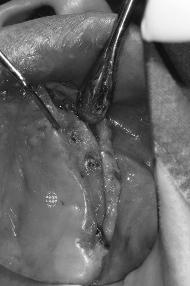 만성치주염으로 인해 아주 좁아진 잇몸뼈에 광범위한 뼈이식 + 전체임플란트. 신사 레브치과. 관련 이미지 41