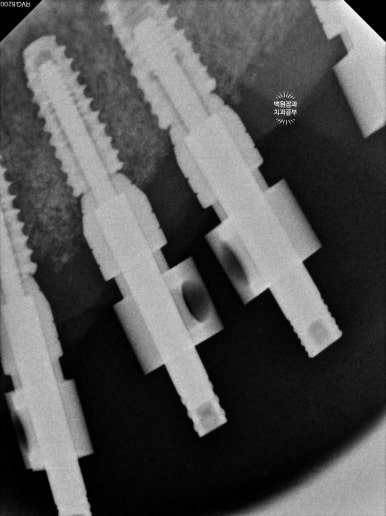 만성치주염으로 인해 아주 좁아진 잇몸뼈에 광범위한 뼈이식 + 전체임플란트. 신사 레브치과. 관련 이미지 47