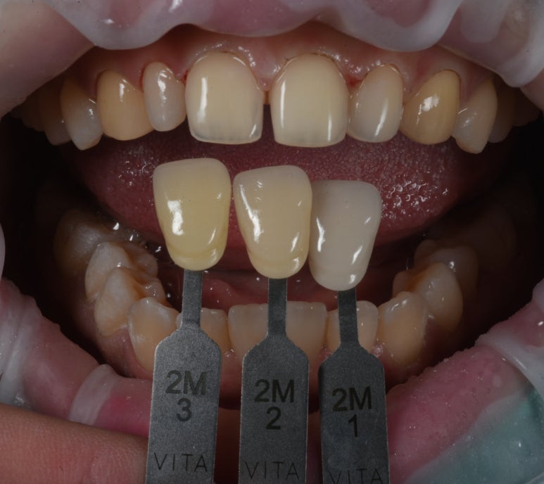 왜소치 라미네이트. 열심히 교정치료 받은 나를 위한 선물. 비용/과정/후기. 관련 이미지 9