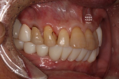 아래 어금니 임플란트 6개면 틀니를 안써도 됩니다.  치주염 전문 착한치과. 치료기간/임시치아과정/후기/비용. 관련 이미지 16