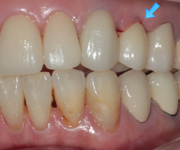 치과의사가 추천하는 가장 좋은 임플란트 회사: 세계 1위 스트라우만 vs 국내 1위 오스템임플란트 비교와 설명. 관련 이미지 11