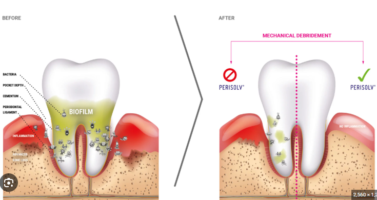 잇몸치료에 대한 모든 것. 치주과 전문의가 설명하는 치주염 치료 비용,과정, 통증, 방법 그리고 치과 실비보험. 관련 이미지 8