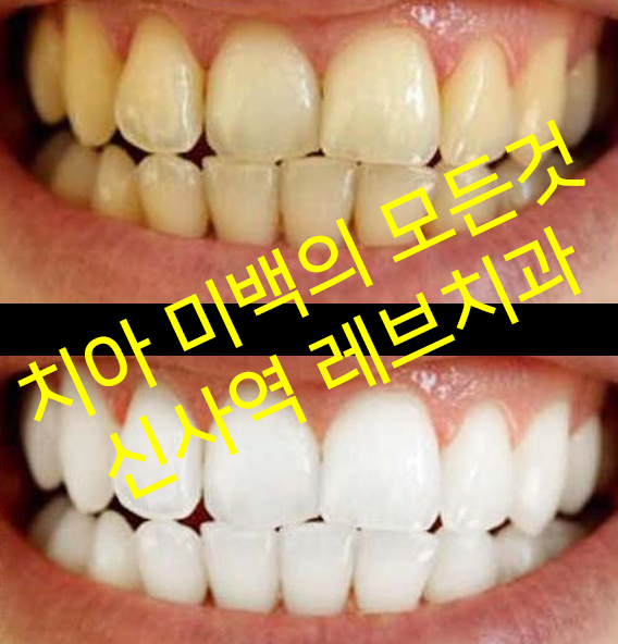 치아미백 시술 치료 받기 전 신사역 치과 체크해야 할 것. 가격/비용/후기. 관련 이미지 1