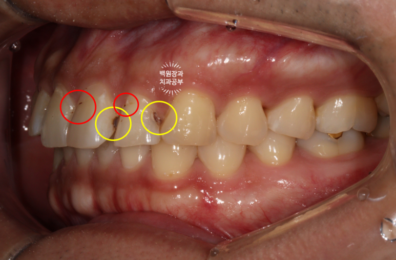 교정 유지장치 근처 앞니 옆면 충치 및 착색 간단히 3M 레진으로 치료. 치료과정/비용/후기. 과잉진료 없는 치과. 관련 이미지 6