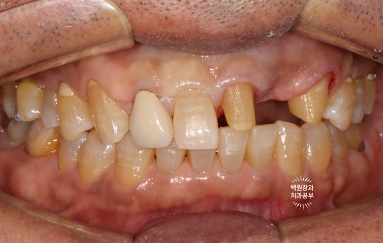 치아와 임플란트를 연결하면 치아가 망가집니다. 발치 동시 치조골 이식 후 임플란트. 치료과정/치료기간/비용/후기. 관련 이미지 3