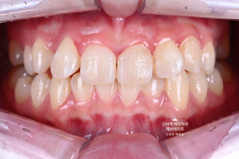 신사역 치과. 아나운서 면접 전 앞니 벌어진 공간을 라미네이트로만 해결할 수 있었던 사연.. 관련 이미지 2