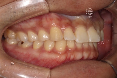 교정 유지장치 근처 앞니 옆면 충치 및 착색 간단히 3M 레진으로 치료. 치료과정/비용/후기. 과잉진료 없는 치과. 관련 이미지 11