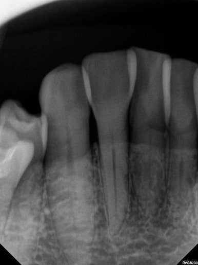 삐뚤어진 앞니를 8개월만에 가지런하게 만드는 50대 성인부분교정. 신사역 교정치과. 치료과정/기간/비용. 관련 이미지 9