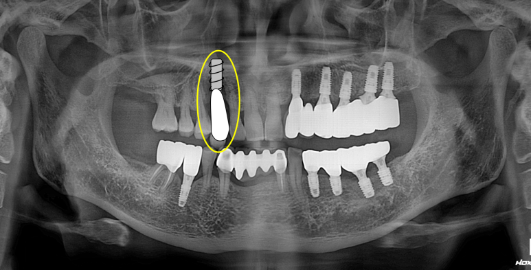 치주염 앞니 잇몸 염증으로 흔들릴 때 - 앞니 브릿지와 임플란트 장단점, 비용. 치료과정과 결과를 눈으로 보여주는 치과. 관련 이미지 9