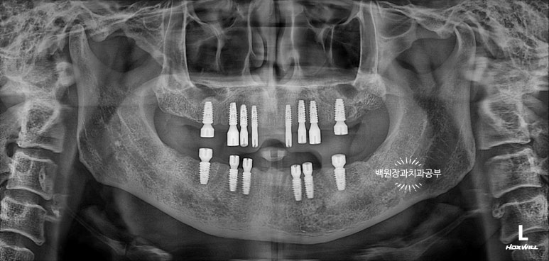 오스템임플란트 네비게이션 전체 임플란트 치료일기. 치료과정/치료기간/비용/솔직후기. 관련 이미지 10