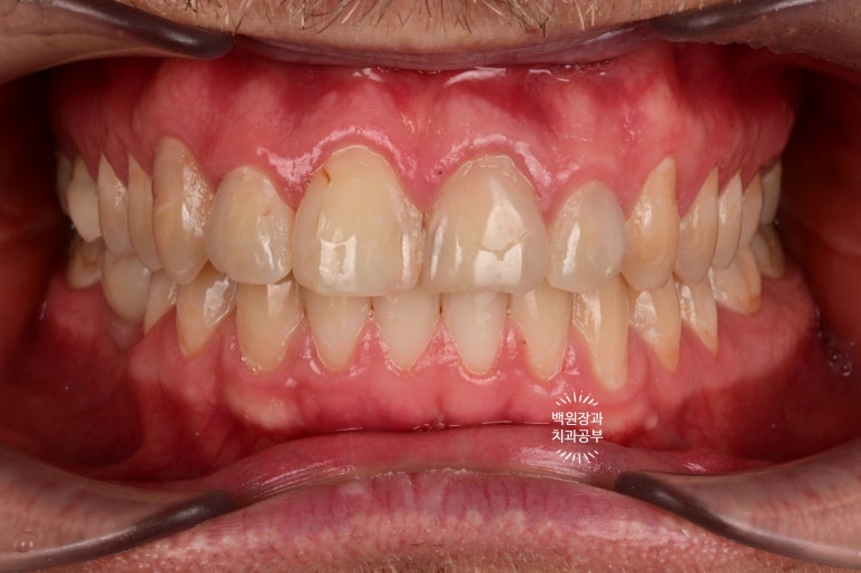 A European Patient at [Rev Dental Clinic] near Sinsa Station in Seoul Wanted Front Tooth Decay Treated with an EMAX All-Ceramic Crown. image 2