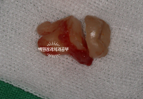 매복 사랑니 10분만에 뽑기! 치료과정/치료기간/비용/후기. 관련 이미지 6