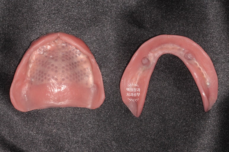 임플란트틀니 - 오버덴쳐. 오스템BA임플란트 이용한 최고의 가성비 치료. 치료과정/치료기간/비용/후기. 관련 이미지 13