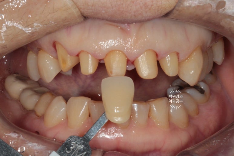 삐뚤빼뚤 앞니 세로 금  - 신경치료 없이 지르코니아 크라운으로. 상악동뼈이식술 임플란트. 관련 이미지 7