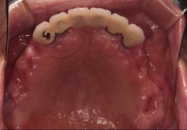 잇몸 염증 고름이 심했던 부위 - 만성치주염 진단하고 임플란트로 깔끔하게 치료! 신사역 치과 관련 이미지 12