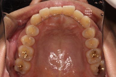 교정 유지장치 근처 앞니 옆면 충치 및 착색 간단히 3M 레진으로 치료. 치료과정/비용/후기. 과잉진료 없는 치과. 관련 이미지 15