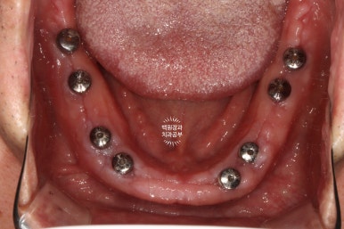 임플란트장인의 마음으로 8개월간 전체임플란트 완성. 치주과 전문의. 관련 이미지 18