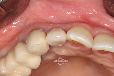 외과적 정출술 (surgical extrusion) - 치아를 살리는 마지막 방법. 치료과정/치료기간/비용/사진. 관련 이미지 15