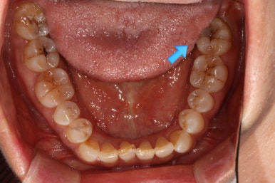 치아크랙 (금간 치아)의 찌릿한 통증 - 발치하지 않고 살려보기. 원인/진단/치료과정/비용/기간. 보존과전문의 치과. 관련 이미지 7