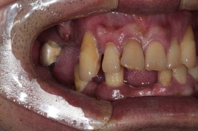 큰 어금니를 잃을 정도의 풍치를 앓으셨다면, 조속한 어금니 임플란트는 필수입니다. 관련 이미지 5