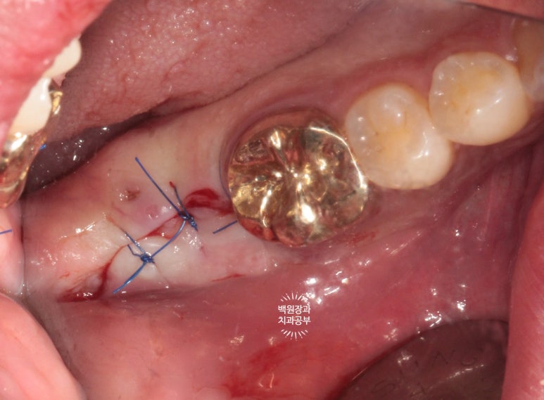 신경치료한 치아 부러짐! 뼈이식 하면서 임플란트 수술하는 과정/기간/비용. 관련 이미지 9