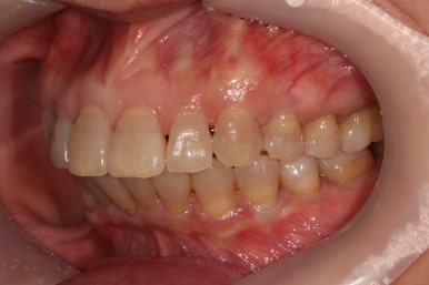 삐뚤어진 앞니를 8개월만에 가지런하게 만드는 50대 성인부분교정. 신사역 교정치과. 치료과정/기간/비용. 관련 이미지 27