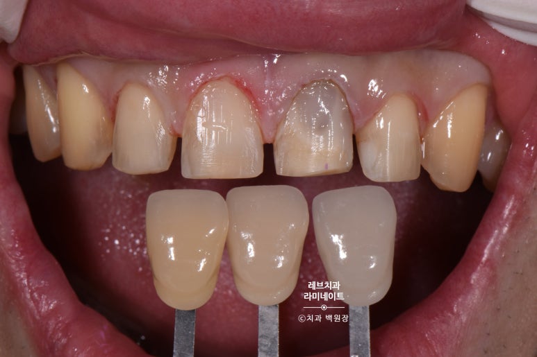 레브네이트 엑스퍼트 ; 유튜버가 선택한 앞니 라미네이트. 앞니 레진 벌어짐을 자연스러우면서 화사하게 바꿔봅시다. 신사역 치과. 치료후기/비용/가격. 관련 이미지 8
