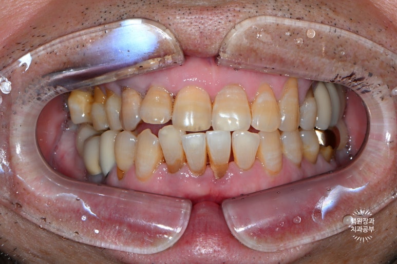 Seoul Sinsa Station [Lev Dental Clinic] For chronic periodontitis, extract the lower front teeth and make the crown look even more real than the real thing with an implant. image 2
