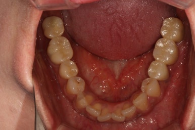 전세계 1위 스트라우만 임플란트를 사용한 어금니 기능회복과 앞니 지르코니아 크라운 증례. 관련 이미지 29
