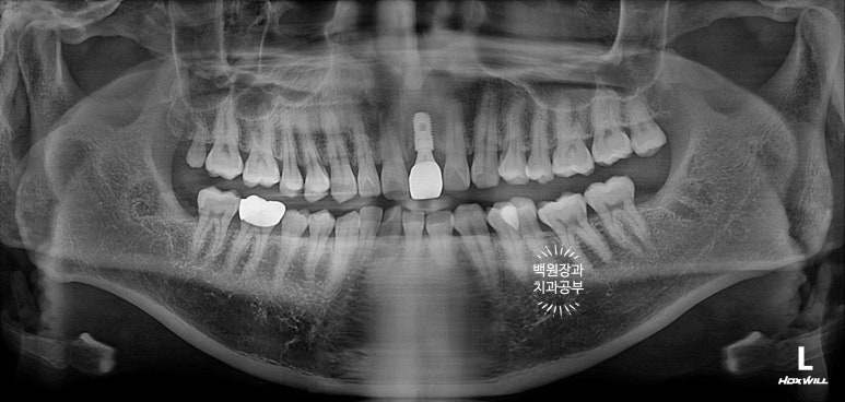 앞니 머리가 기둥째 부러졌어요. 발치 동시 뼈이식 오스템 BA 임플란트. 치료과정/치료기간/비용/후기. 압구정 치과. 관련 이미지 25