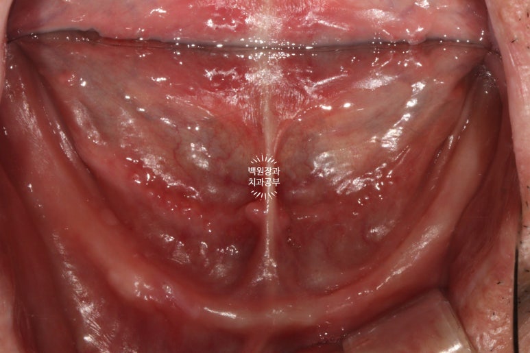 아래 어금니 임플란트 6개면 틀니를 안써도 됩니다.  치주염 전문 착한치과. 치료기간/임시치아과정/후기/비용. 관련 이미지 8
