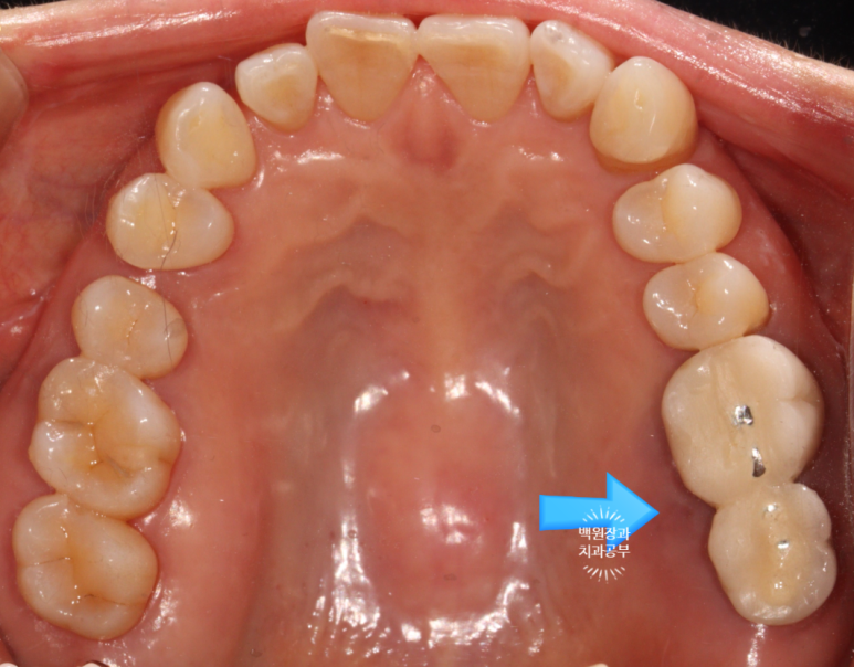 치아와 임플란트를 연결하면 치아가 망가집니다. 발치 동시 치조골 이식 후 임플란트. 치료과정/치료기간/비용/후기. 관련 이미지 7