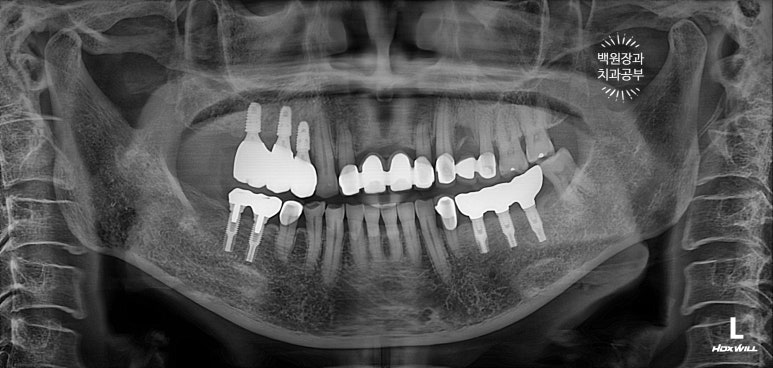 60대 임플란트 주변에서 고름이 나와요. 실패한 임플란트 제거 후 재수술. 덴티움 뼈이식재를 사용한 치조골 이식술. 관련 이미지 16