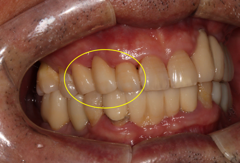치주염 앞니 잇몸 염증으로 흔들릴 때 - 앞니 브릿지와 임플란트 장단점, 비용. 치료과정과 결과를 눈으로 보여주는 치과. 관련 이미지 15