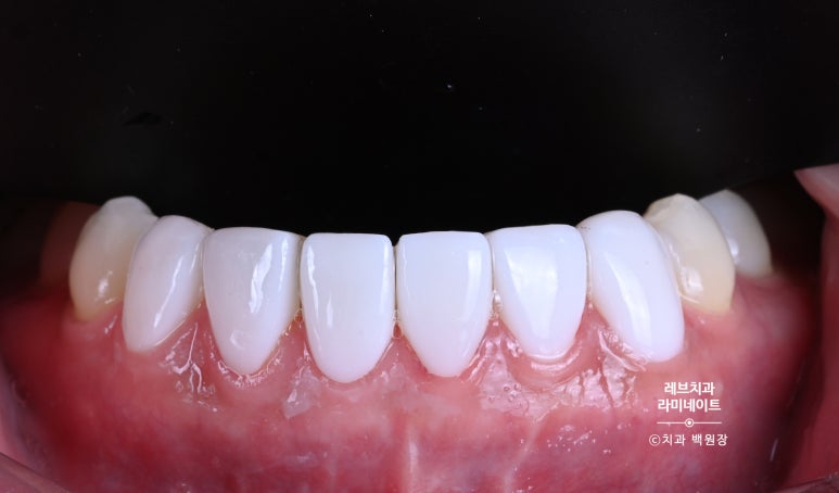 레브네이트 베이직. 치아미백과 치아교정을 한번에! 치아삭제 사진 있음. 신사역 치과 앞니라미네이트 모델/비용/후기. 관련 이미지 18
