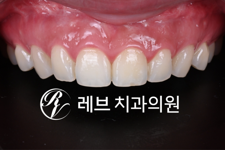 신사역 라미네이트, 잘하는 치과의 치료과정과 재료.설명.비용.후기. 관련 이미지 1