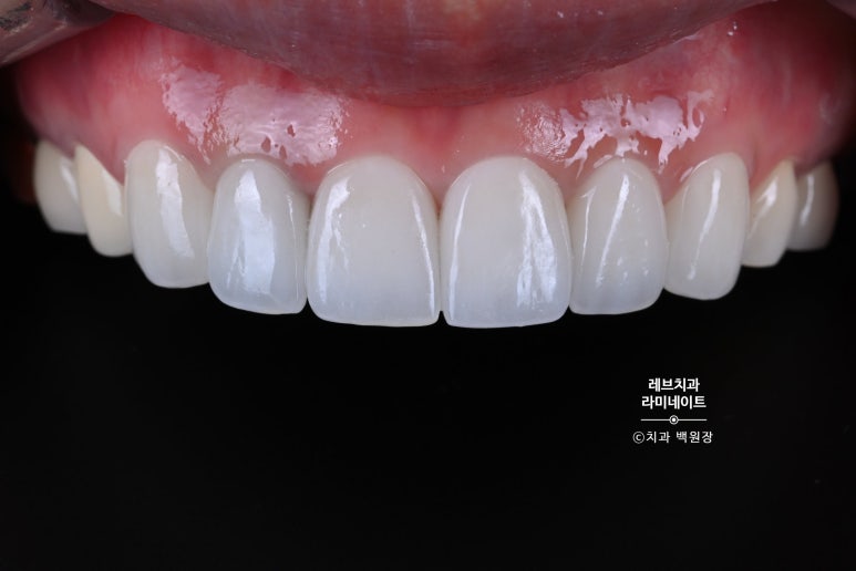 신사역 퍼스널컬러 맞춤 치과. 전담 세라미스트가 앞니 크라운과 라미네이트를 만들어 드립니다. 관련 이미지 10