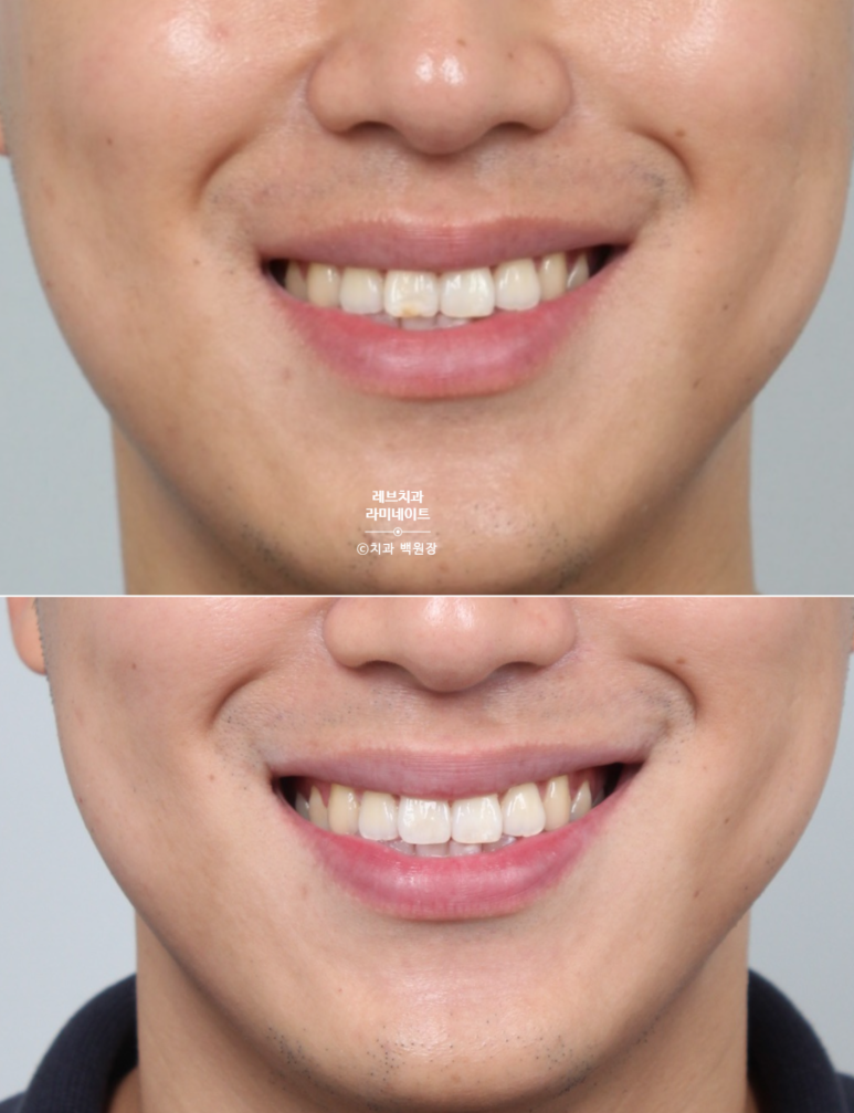 레브네이트 마스터 ; 예비신랑 앞니 무삭제라미네이트. 신사역 치과. 치료후기/비용/가격. 관련 이미지 17
