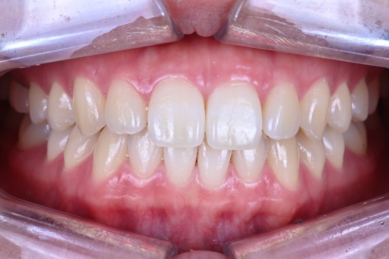 강남 치아미백 성지 레브치과. 가격/비용/부작용/전후사진. 관련 이미지 11